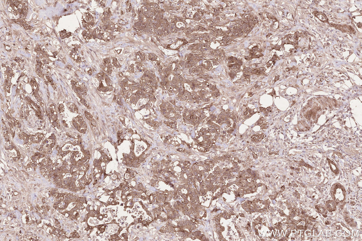 Immunohistochemical analysis of paraffin-embedded human rectal cancer tissue slide using KHC2564 (DAB2IP IHC Kit).