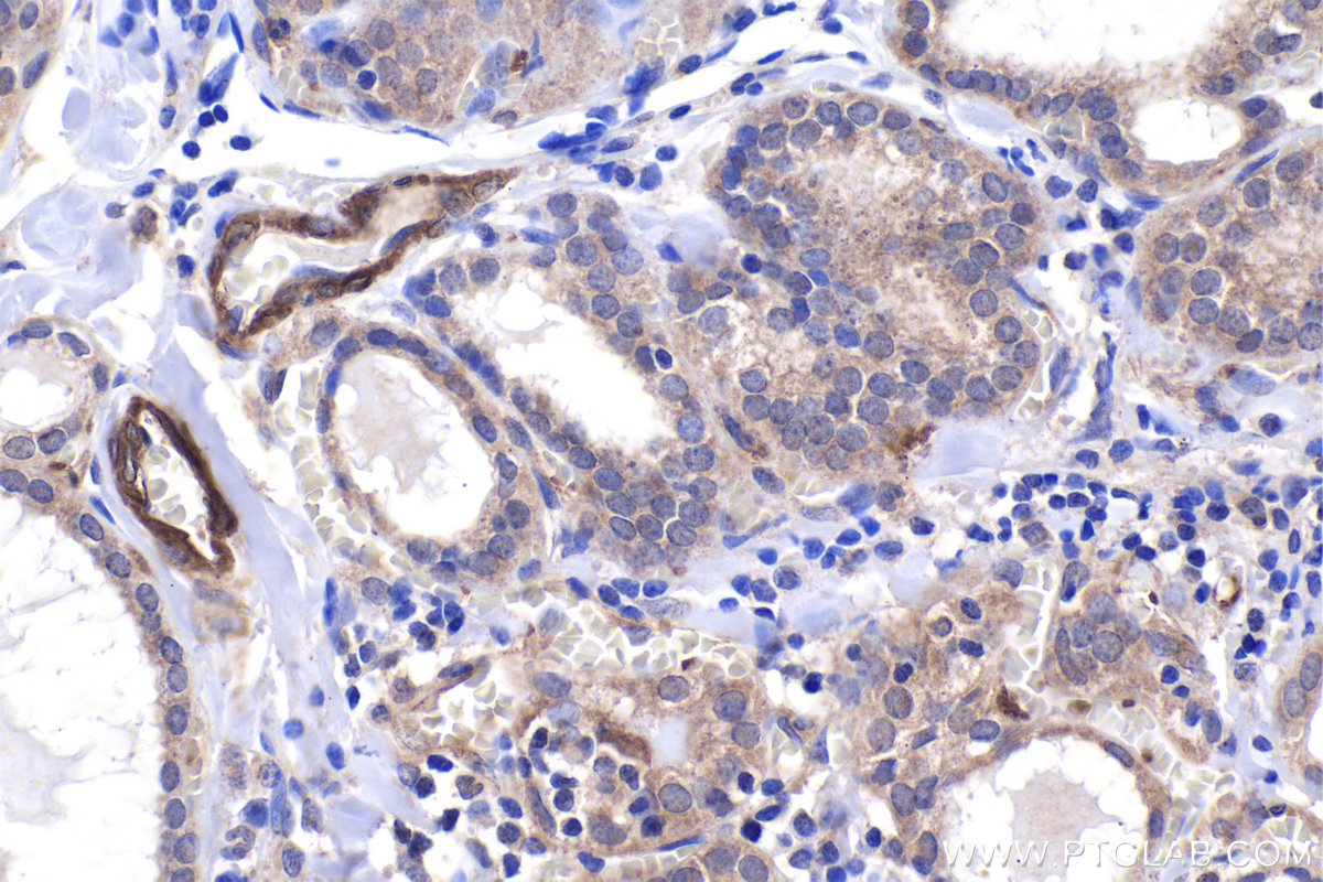 Immunohistochemical analysis of paraffin-embedded human thyroid cancer tissue slide using KHC1972 (DACT1 IHC Kit).