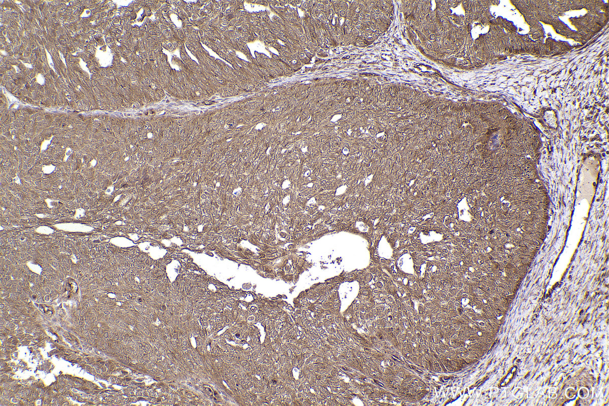 Immunohistochemical analysis of paraffin-embedded human ovary cancer tissue slide using KHC2434 (DCTN2 IHC Kit).