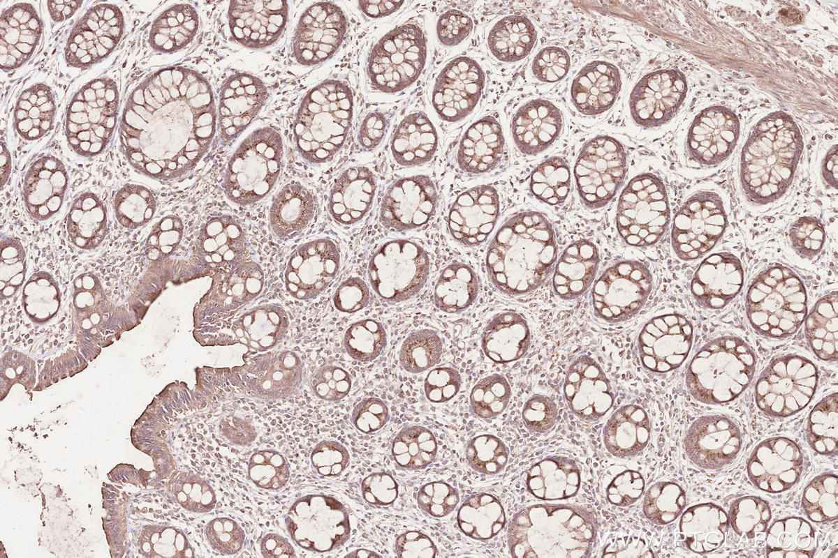 Immunohistochemical analysis of paraffin-embedded human rectal cancer tissue slide using KHC2523 (DDR2 IHC Kit).