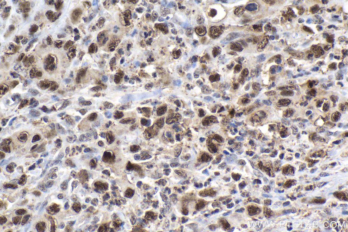 Immunohistochemical analysis of paraffin-embedded human stomach cancer tissue slide using KHC2015 (DIS3 IHC Kit).