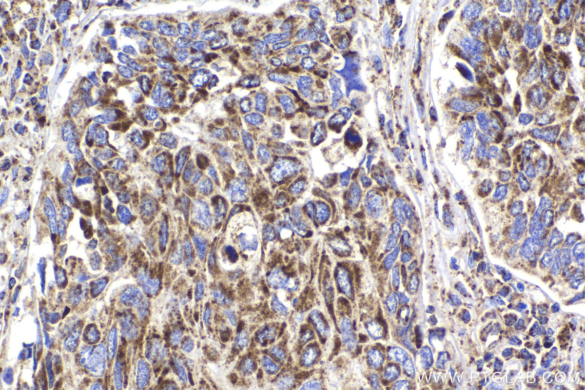 Immunohistochemical analysis of paraffin-embedded human lung cancer tissue slide using KHC2172 (DLD IHC Kit).