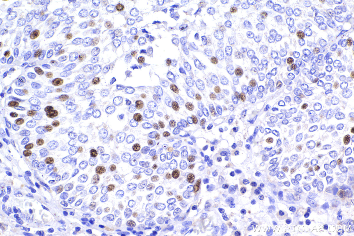 Immunohistochemical analysis of paraffin-embedded human urothelial carcinoma tissue slide using KHC2394 (DUSP2 IHC Kit).