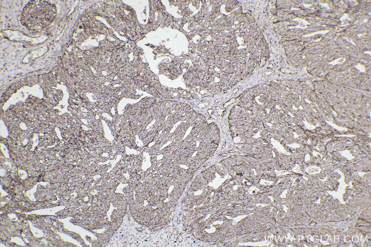 Immunohistochemical analysis of paraffin-embedded human ovary cancer tissue slide using KHC2521 (DUSP6 IHC Kit).