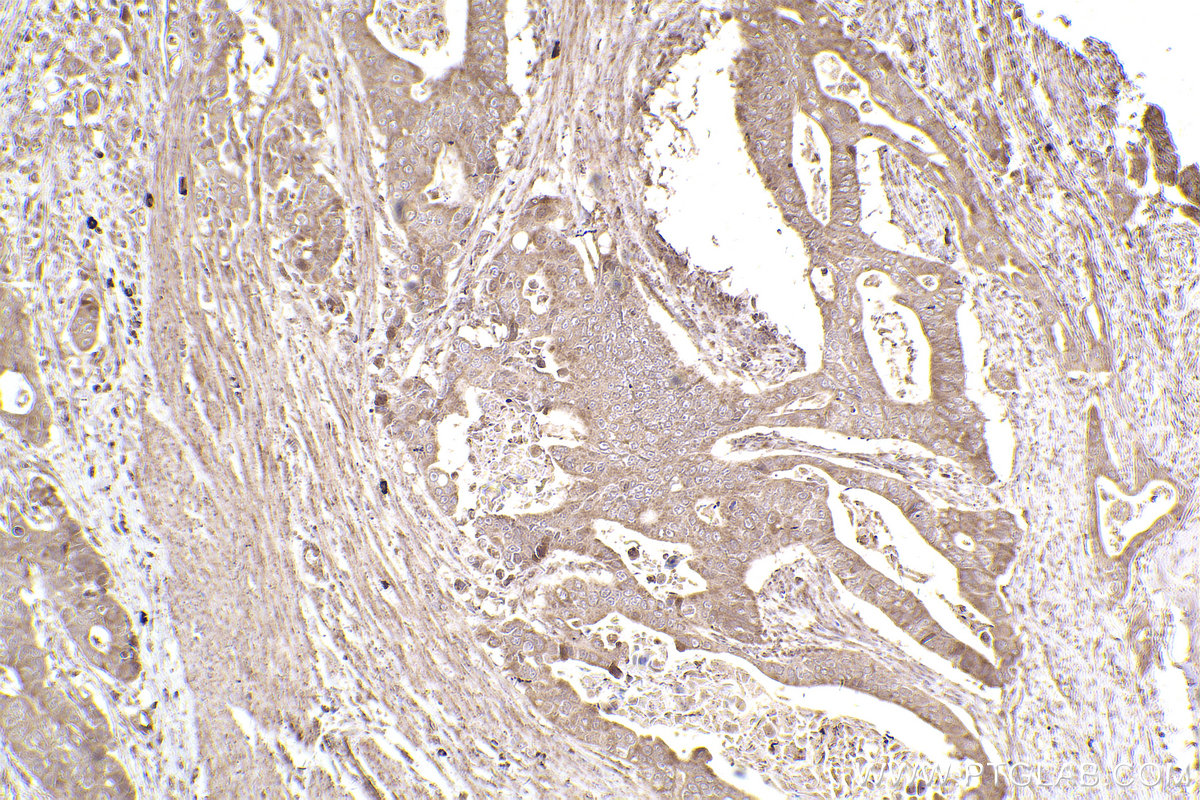 Immunohistochemical analysis of paraffin-embedded human stomach cancer tissue slide using KHC2522 (DUSP7 IHC Kit).