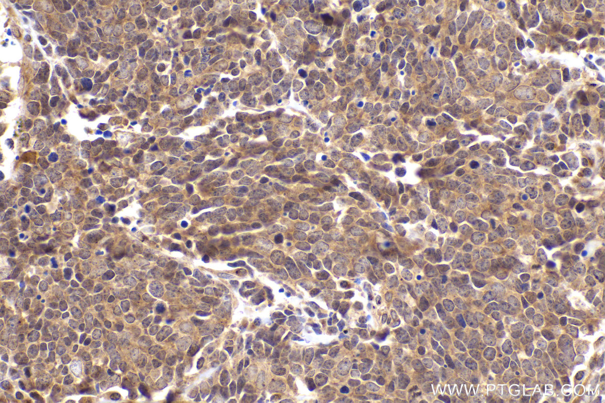 Immunohistochemical analysis of paraffin-embedded human lung cancer tissue slide using KHC2426 (DYNC1I2 IHC Kit).