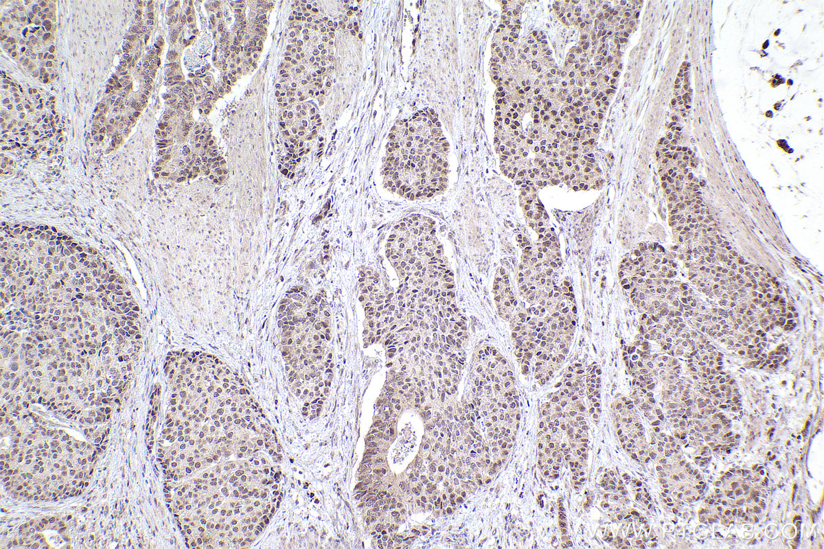 Immunohistochemical analysis of paraffin-embedded human stomach cancer tissue slide using KHC2539 (EAPP IHC Kit).