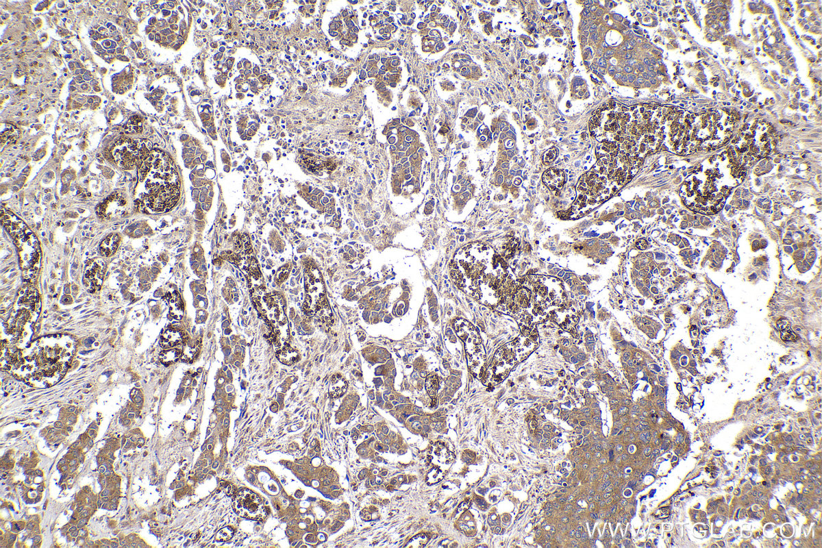 Immunohistochemical analysis of paraffin-embedded human stomach cancer tissue slide using KHC2177 (EPB41 IHC Kit).