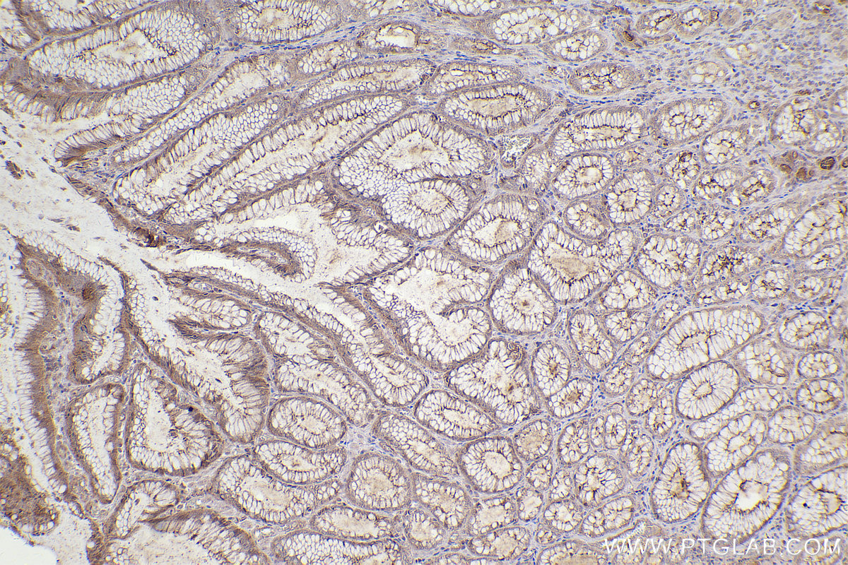 Immunohistochemical analysis of paraffin-embedded human stomach cancer tissue slide using KHC2411 (EPS8 IHC Kit).