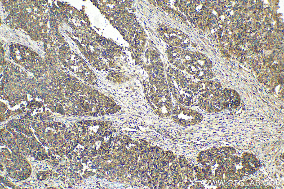 Immunohistochemical analysis of paraffin-embedded human ovary cancer tissue slide using KHC2117 (ERAL1 IHC Kit).