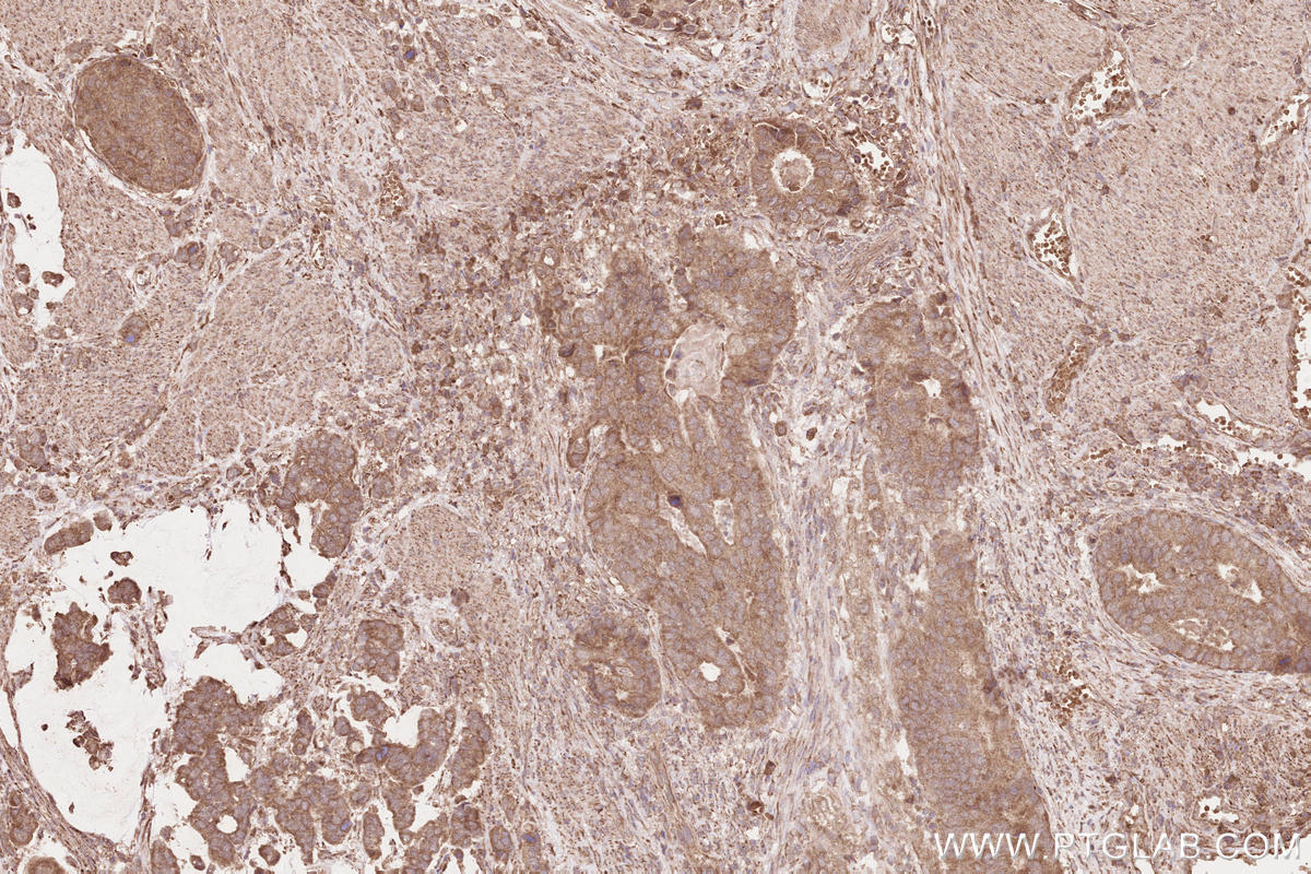 Immunohistochemical analysis of paraffin-embedded human stomach cancer tissue slide using KHC2567 (FBXO31 IHC Kit).