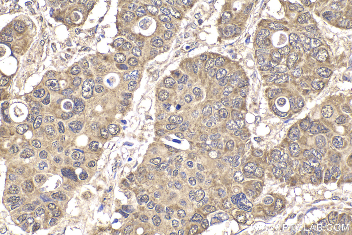 Immunohistochemical analysis of paraffin-embedded human stomach cancer tissue slide using KHC2167 (FH IHC Kit).