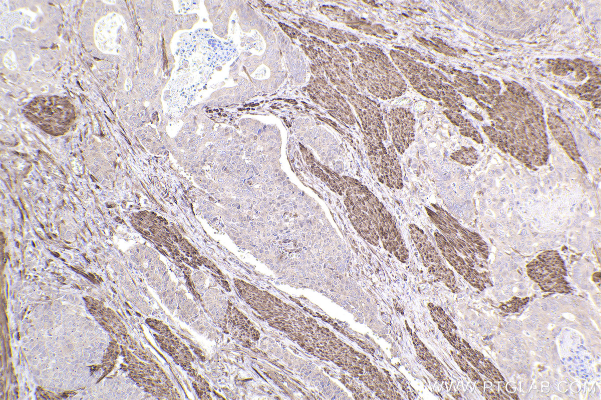 Immunohistochemical analysis of paraffin-embedded human stomach cancer tissue slide using KHC2441 (FHL1 IHC Kit).