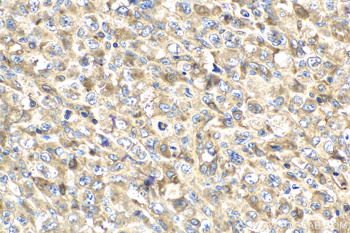 Immunohistochemical analysis of paraffin-embedded human lymphoma tissue slide using KHC2164 (FYN IHC Kit).
