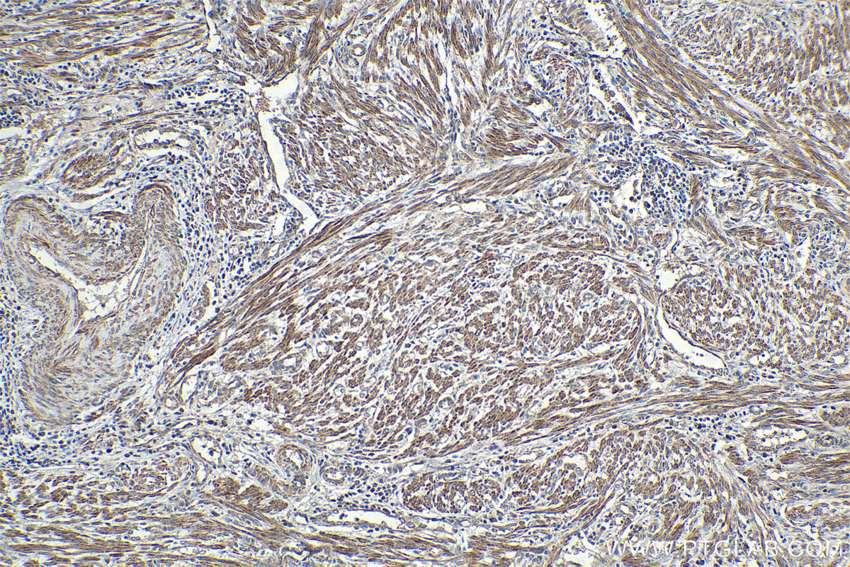 Immunohistochemical analysis of paraffin-embedded human endometrial cancer tissue slide using KHC2096 (GDF9 IHC Kit).