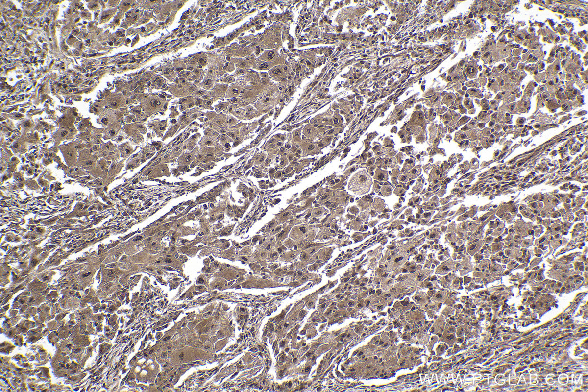 Immunohistochemical analysis of paraffin-embedded human lung cancer tissue slide using KHC1969 (GID8 IHC Kit).