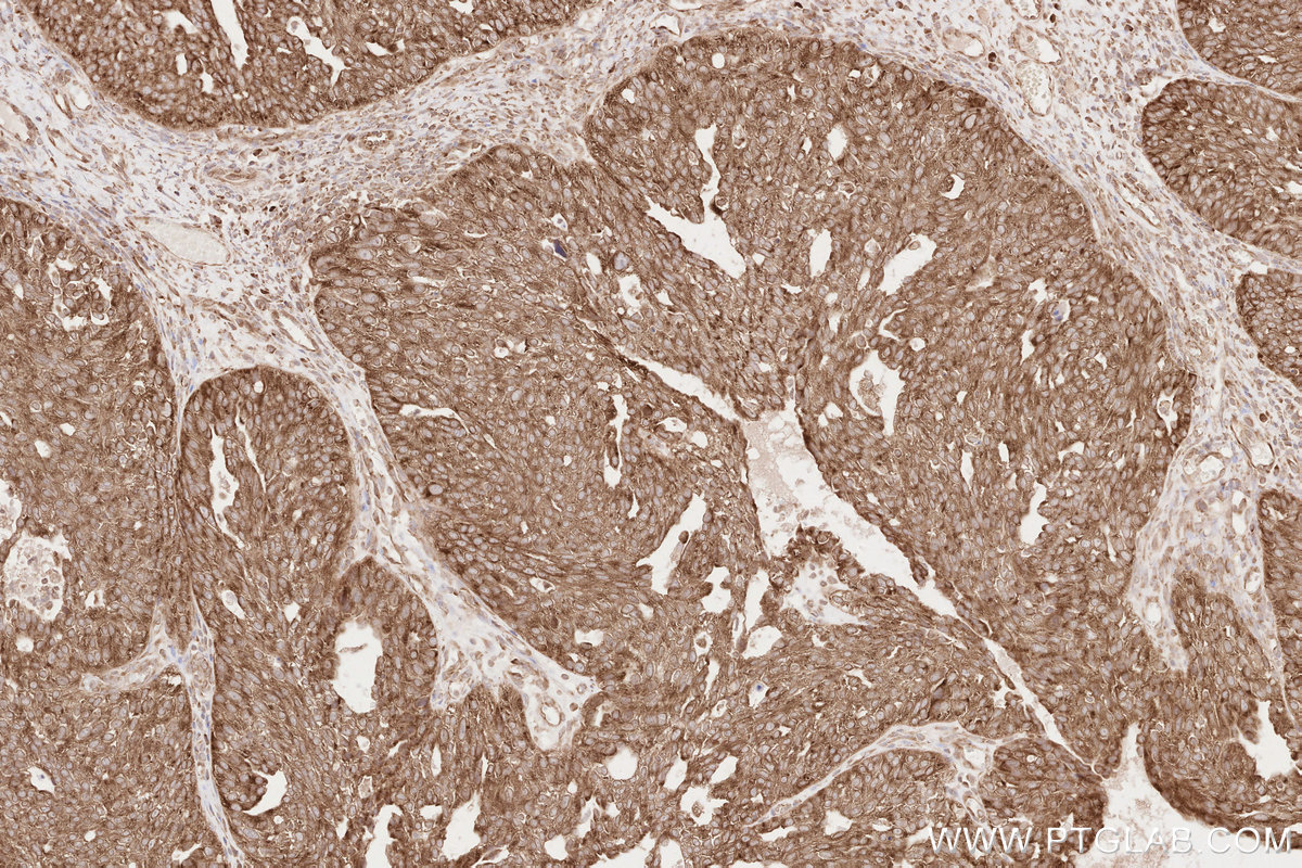 Immunohistochemical analysis of paraffin-embedded human ovary cancer tissue slide using KHC2601 (GIGYF2 IHC Kit).