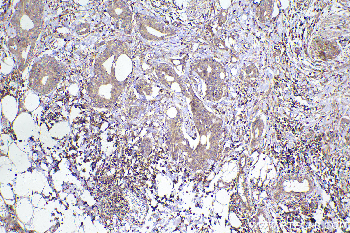 Immunohistochemical analysis of paraffin-embedded human rectal cancer tissue slide using KHC2451 (GIT2 IHC Kit).