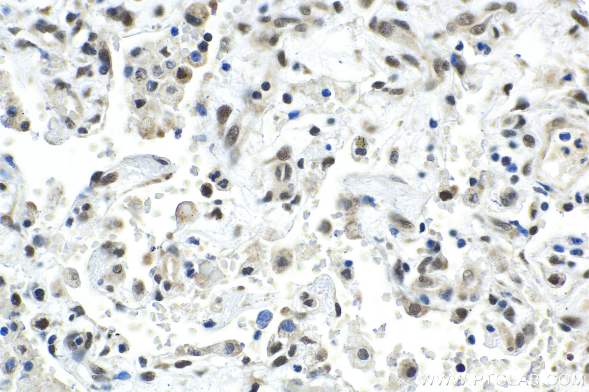 Immunohistochemical analysis of paraffin-embedded human lung tissue slide using KHC1993 (GTF3C4 IHC Kit).