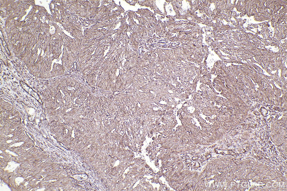 Immunohistochemical analysis of paraffin-embedded human ovary cancer tissue slide using KHC2508 (GUK1 IHC Kit).