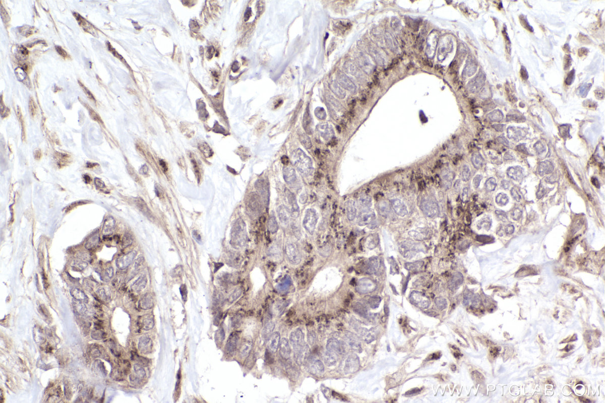 Immunohistochemical analysis of paraffin-embedded human rectal cancer tissue slide using KHC2468 (Giantin IHC Kit).