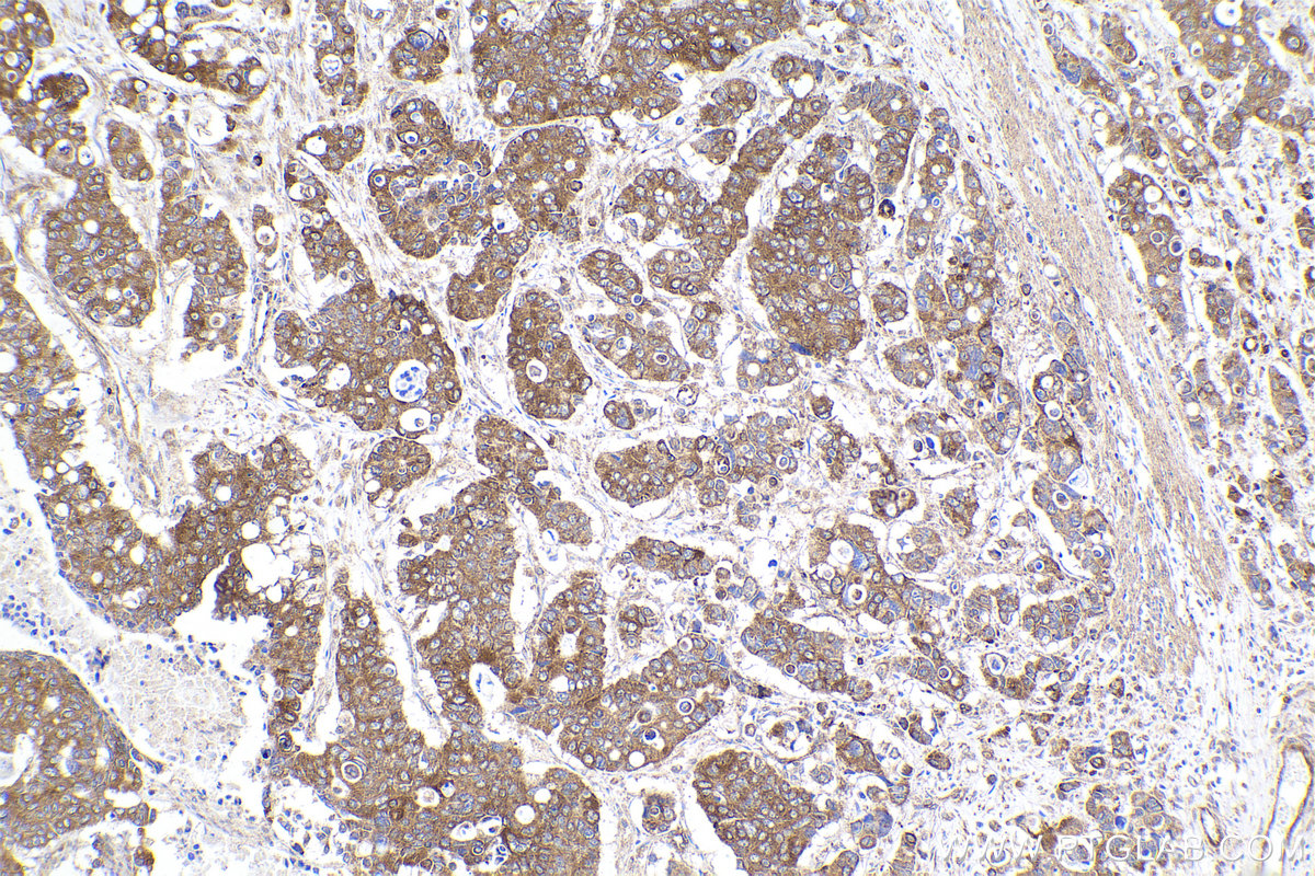 Immunohistochemical analysis of paraffin-embedded human stomach cancer tissue slide using KHC2229 (HMOX2 IHC Kit).