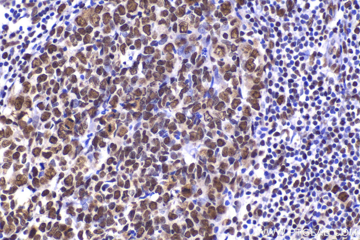 Immunohistochemical analysis of paraffin-embedded human appendicitis tissue slide using KHC2236 (HNRNPH1 IHC Kit).