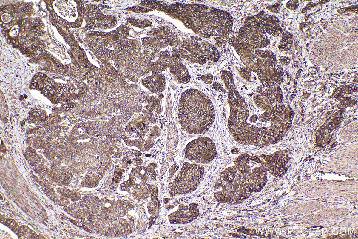 Immunohistochemical analysis of paraffin-embedded human stomach cancer tissue slide using KHC2534 (HSD17B12 IHC Kit).