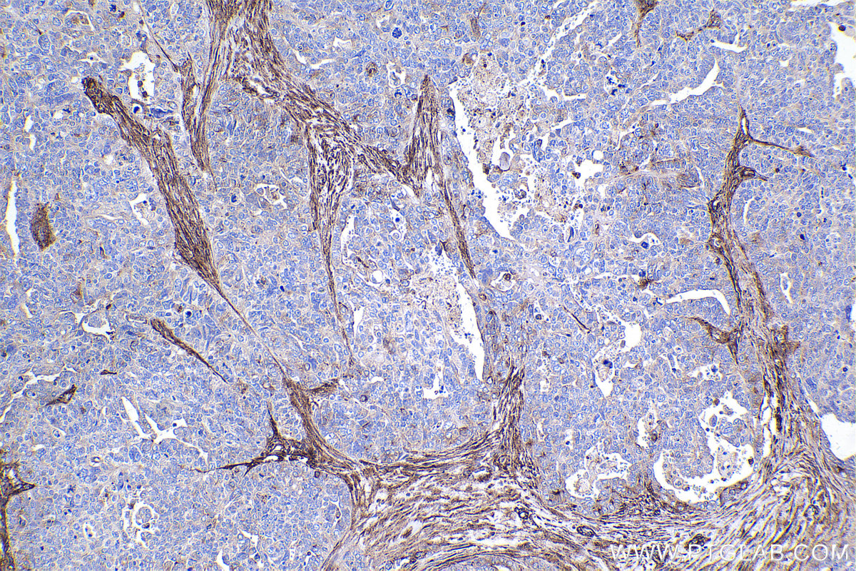 Immunohistochemical analysis of paraffin-embedded human ovary tumor tissue slide using KHC2383 (IFITM2 IHC Kit).