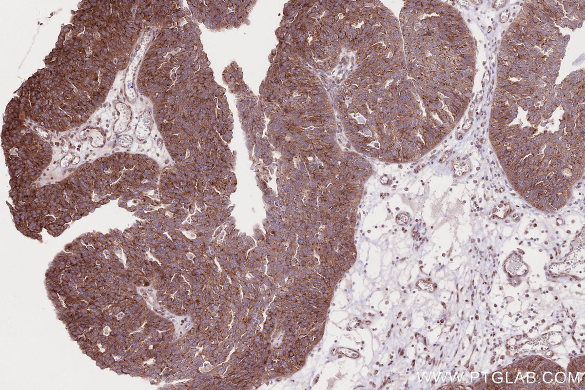 Immunohistochemical analysis of paraffin-embedded human ovary cancer tissue slide using KHC2656 (IFT20 IHC Kit).