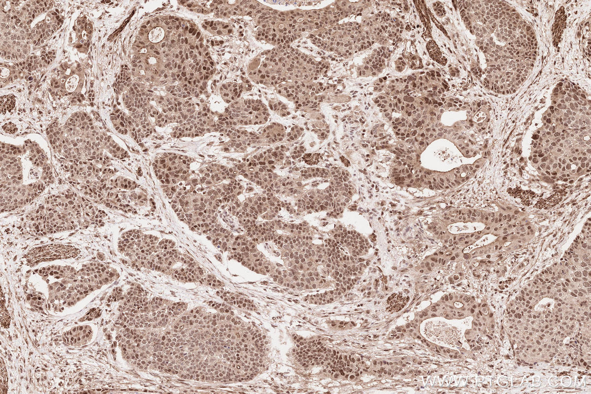 Immunohistochemical analysis of paraffin-embedded human stomach cancer tissue slide using KHC2573 (INTS3 IHC Kit).