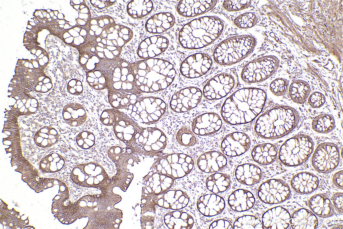 Immunohistochemical analysis of paraffin-embedded human rectal cancer tissue slide using KHC2498 (Intersectin 1/ITSN1 IHC Kit).