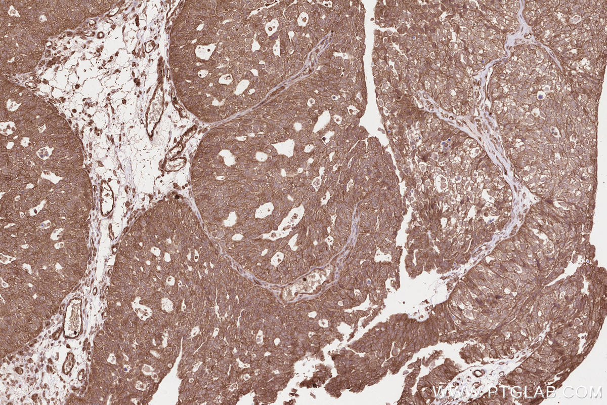 Immunohistochemical analysis of paraffin-embedded human ovary cancer tissue slide using KHC2569 (KANK2 IHC Kit).