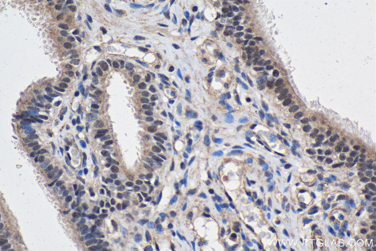 Immunohistochemical analysis of paraffin-embedded human ovary tumor tissue slide using KHC2104 (KIN IHC Kit).
