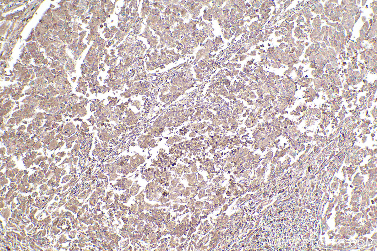 Immunohistochemical analysis of paraffin-embedded human lung cancer tissue slide using KHC2535 (KLHL22 IHC Kit).