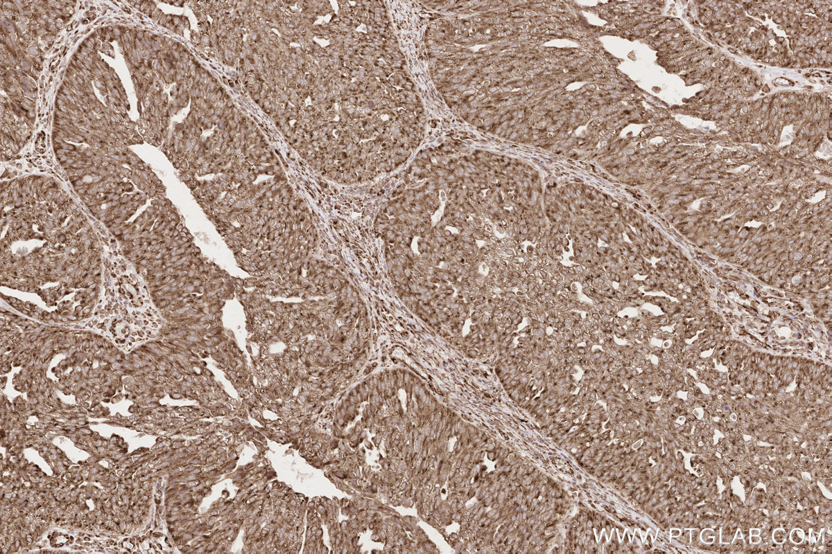 Immunohistochemical analysis of paraffin-embedded human ovary cancer tissue slide using KHC2635 (KTN1 IHC Kit).