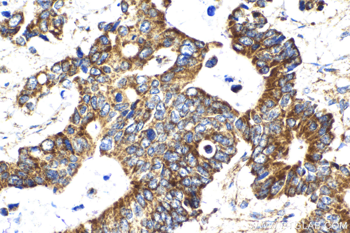 Immunohistochemical analysis of paraffin-embedded human stomach cancer tissue slide using KHC2135 (LETM1 IHC Kit).