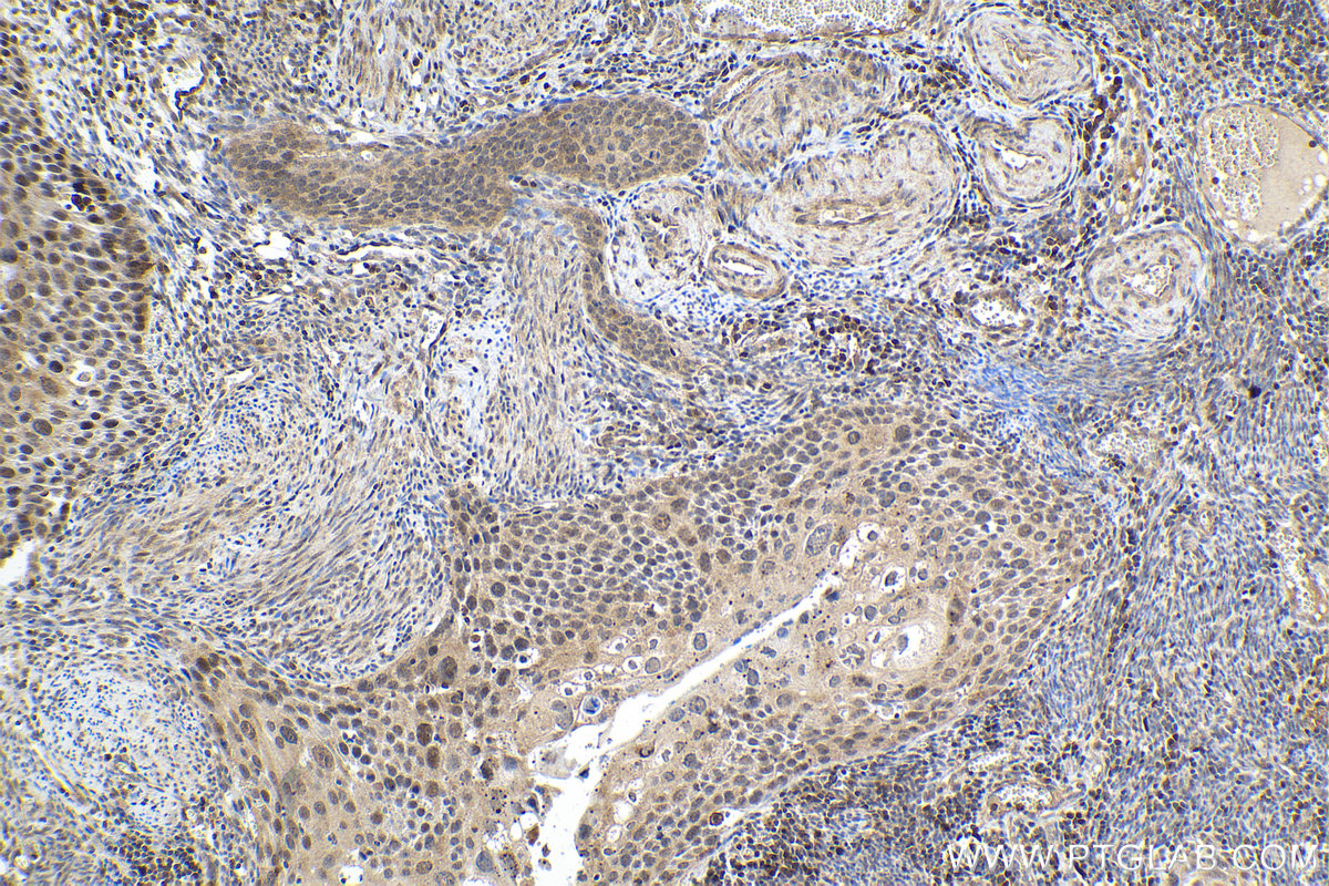 Immunohistochemical analysis of paraffin-embedded human cervical cancer tissue slide using KHC1980 (LIMD1 IHC Kit).