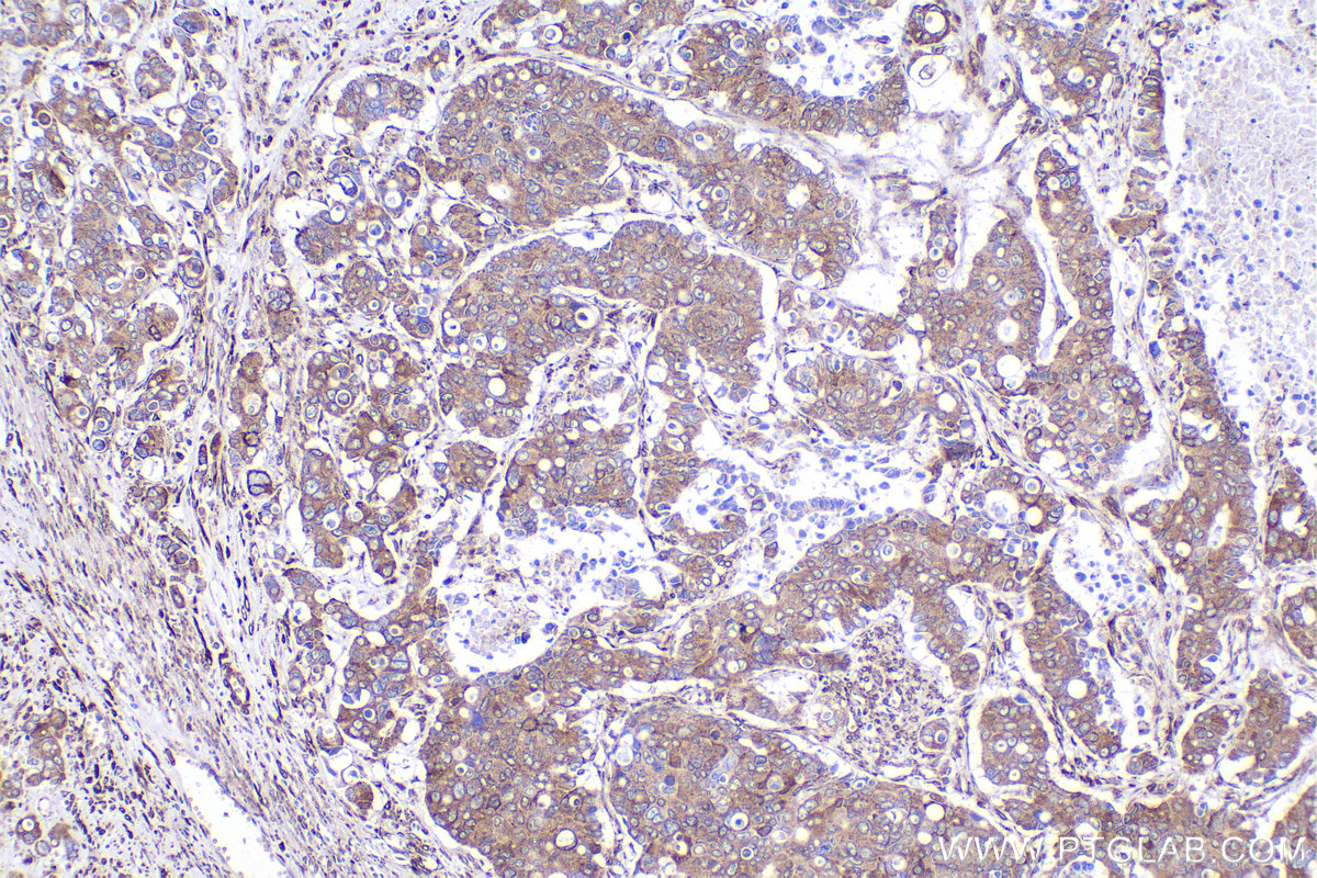 Immunohistochemical analysis of paraffin-embedded human stomach cancer tissue slide using KHC2287 (LMAN1 IHC Kit).