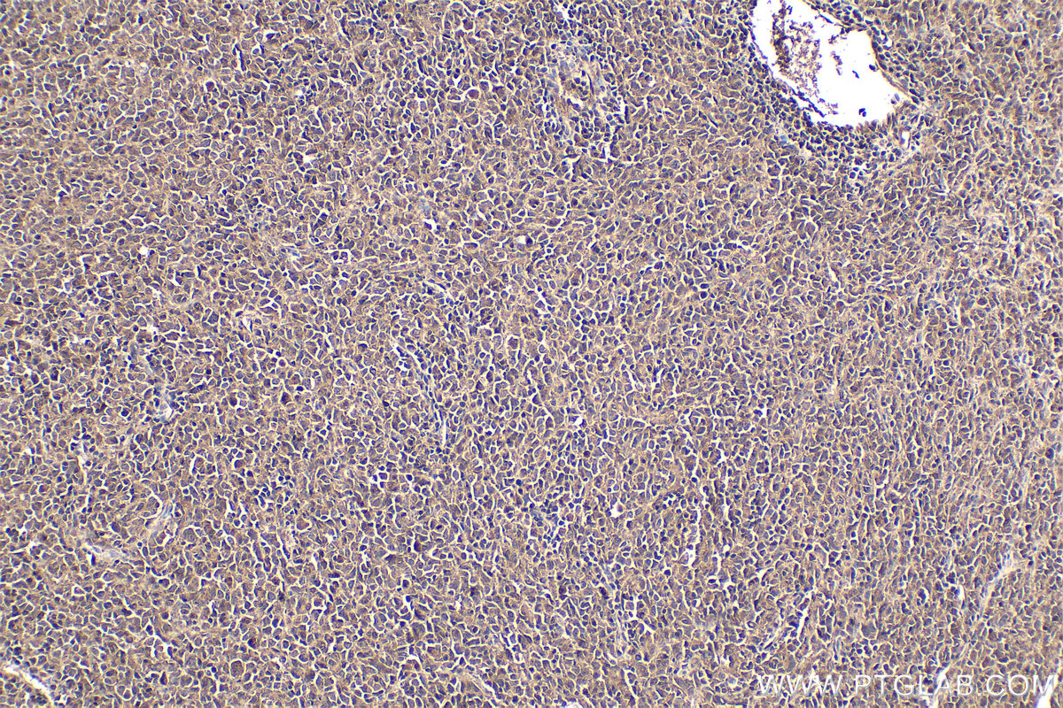 Immunohistochemical analysis of paraffin-embedded human malignant melanoma tissue slide using KHC2141 (LRAT IHC Kit).