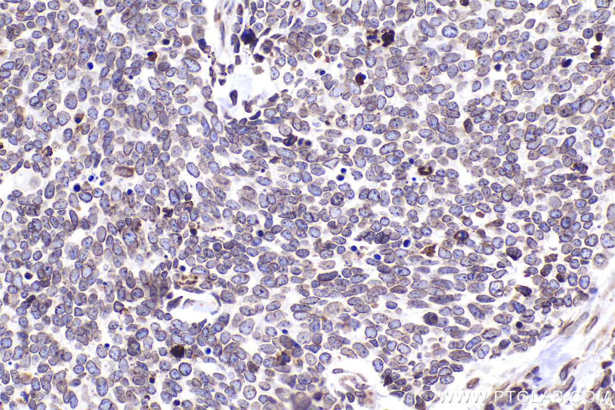 Immunohistochemical analysis of paraffin-embedded human lung cancer tissue slide using KHC2389 (Lamin B2 IHC Kit).