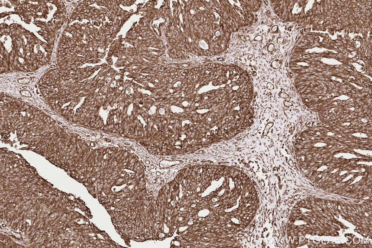 Immunohistochemical analysis of paraffin-embedded human ovary cancer tissue slide using KHC2571 (MAP1S IHC Kit).