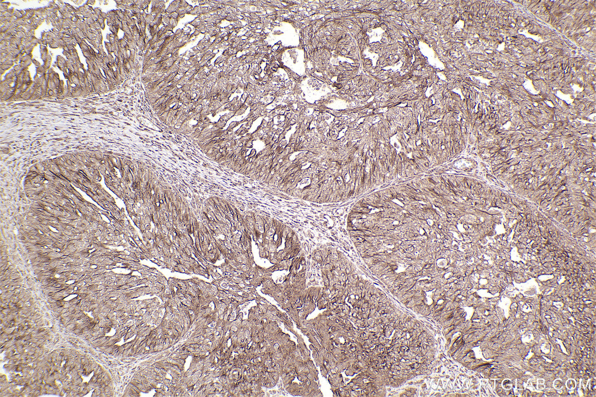 Immunohistochemical analysis of paraffin-embedded human ovary cancer tissue slide using KHC2531 (MAP9 IHC Kit).