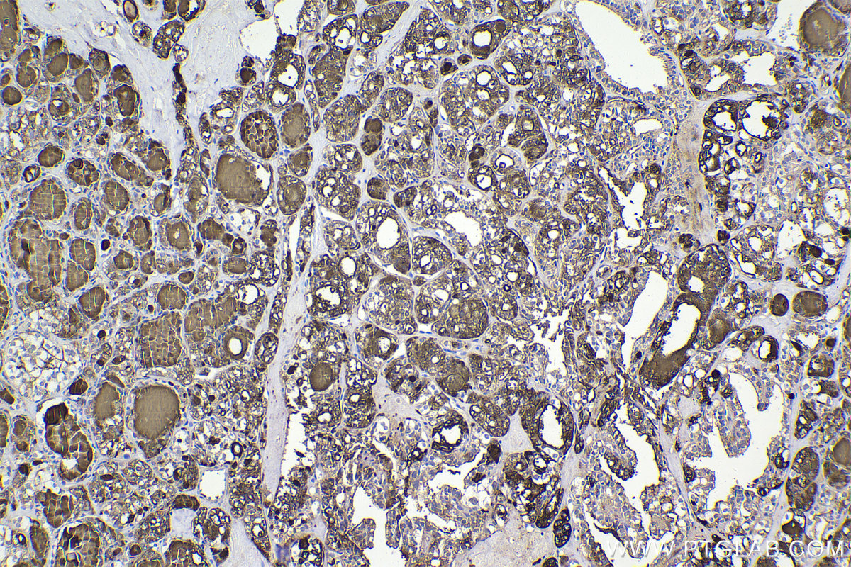 Immunohistochemical analysis of paraffin-embedded human thyroid cancer tissue slide using KHC2347 (MAPKAPK2 IHC Kit).