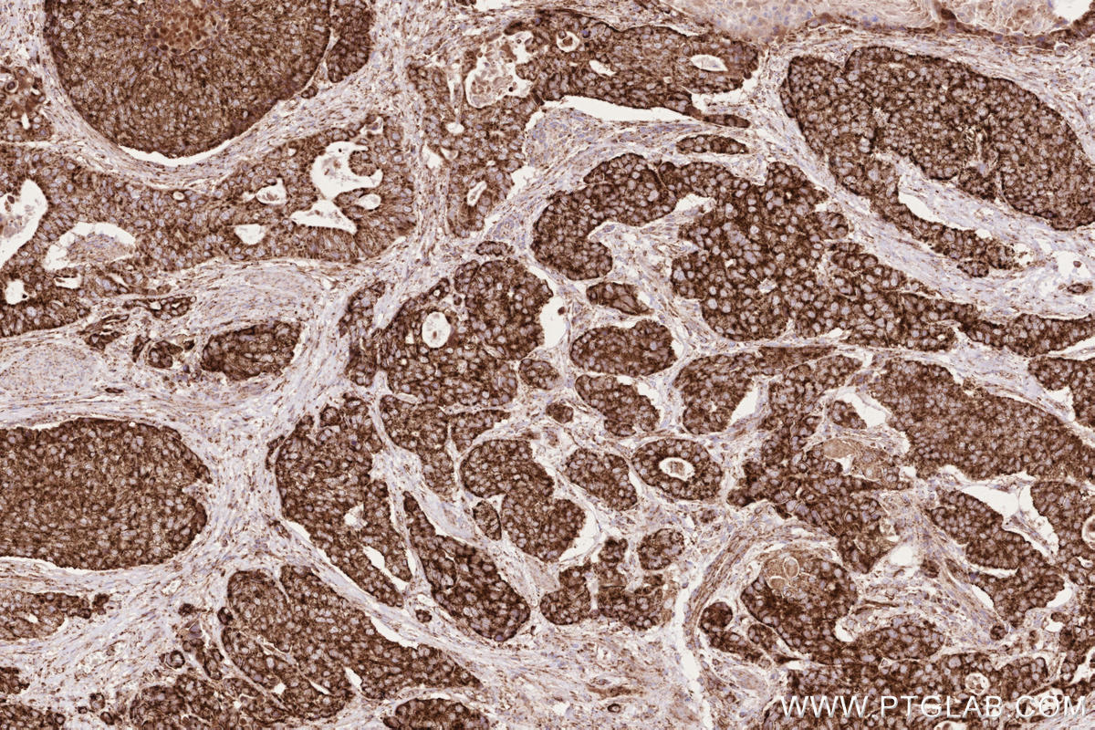 Immunohistochemical analysis of paraffin-embedded human stomach cancer tissue slide using KHC2620 (MAVS IHC Kit).