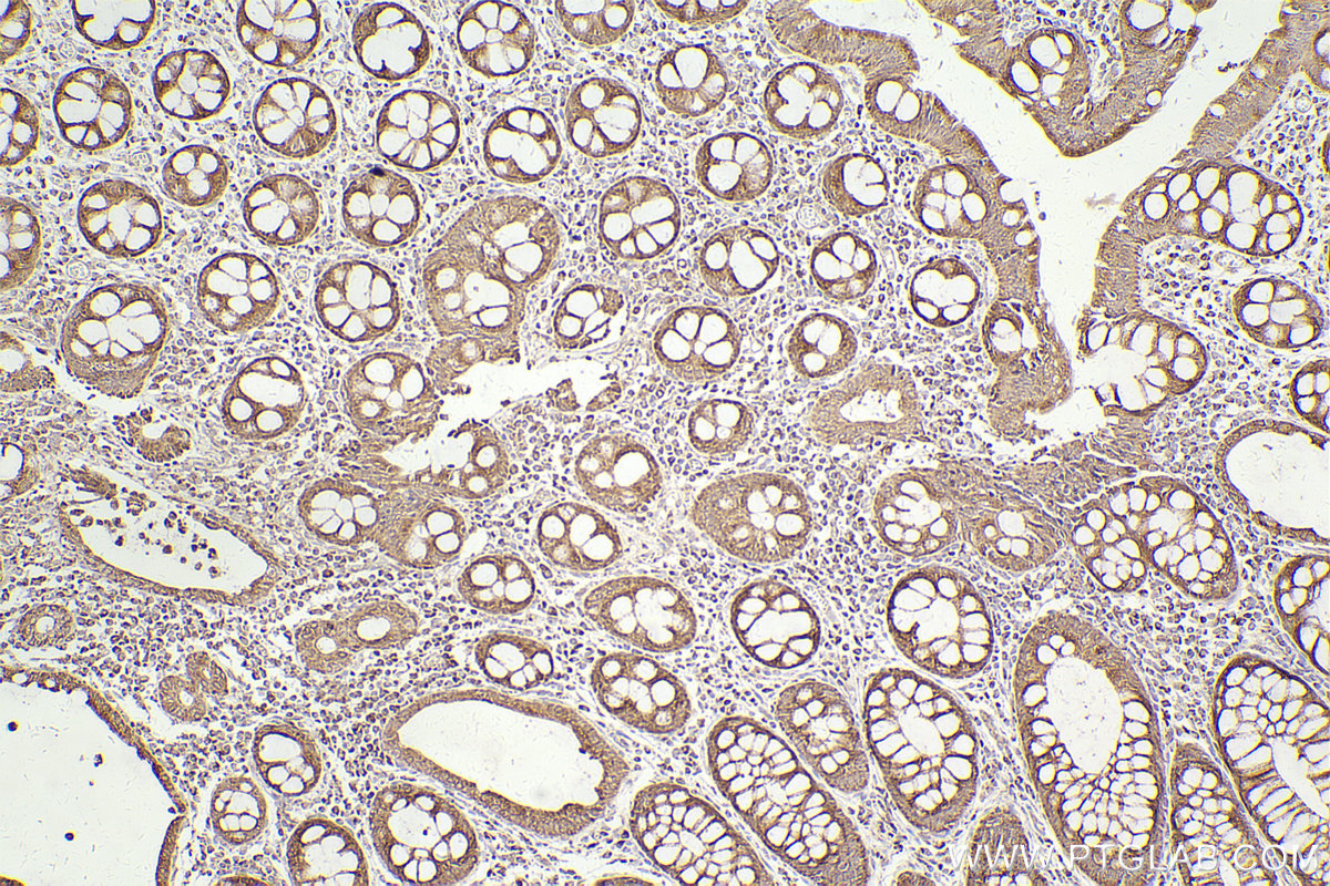 Immunohistochemical analysis of paraffin-embedded human rectal cancer tissue slide using KHC2464 (MELK IHC Kit).