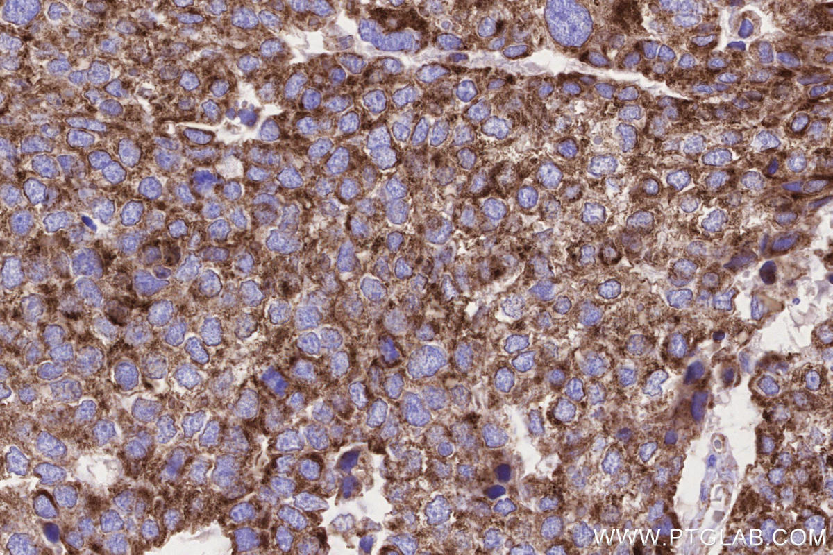 Immunohistochemical analysis of paraffin-embedded human stomach cancer tissue slide using KHC2650 (MFN1 IHC Kit).