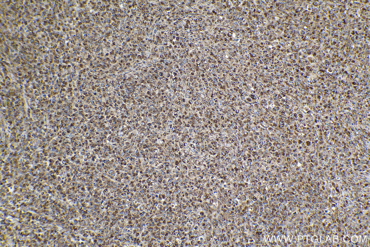 Immunohistochemical analysis of paraffin-embedded human lymphoma tissue slide using KHC2133 (MFN2 IHC Kit).