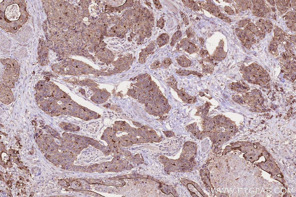 Immunohistochemical analysis of paraffin-embedded human stomach cancer tissue slide using KHC2648 (MISP/C19orf21 IHC Kit).