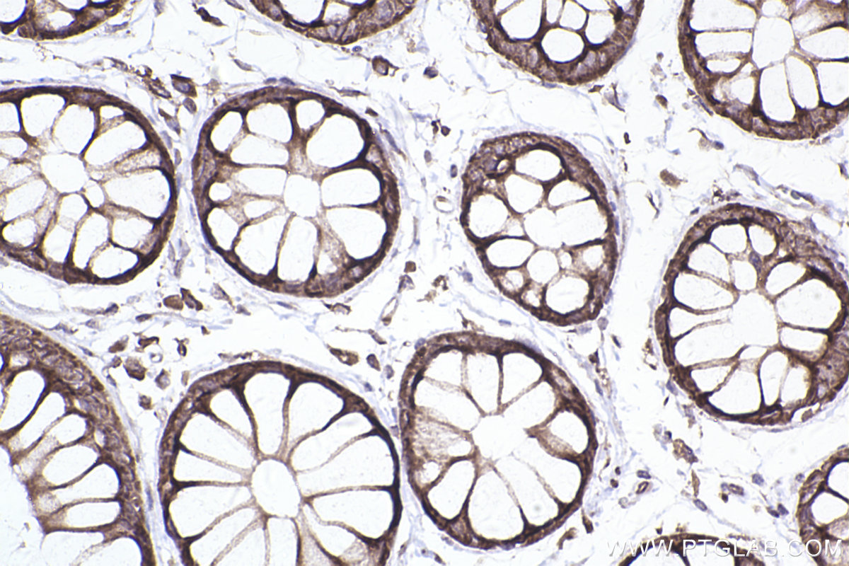 Immunohistochemical analysis of paraffin-embedded human rectal cancer tissue slide using KHC2452 (MLEC/Malectin IHC Kit).